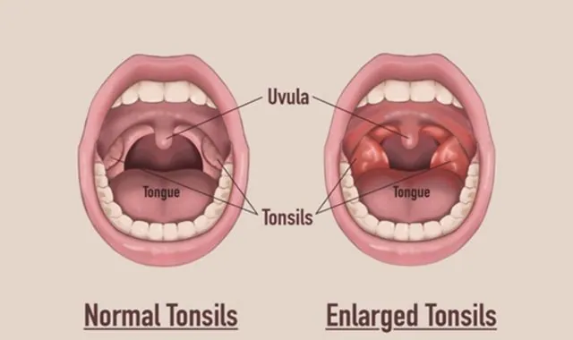 Do Tonsils Grow Back Understanding Tonsil Health